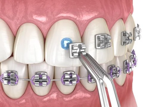 Metal braces installation process. Medically accurate dental 3D illustration Stock Illustration