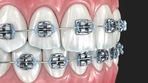 Metal braces on teeth, macro view. 3D animation Stock Footage 314452980