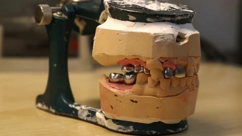 Metal frame on implants prepared for the application of ceramic mass Stock Footage 212148397