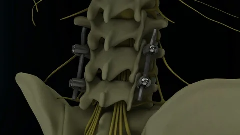 Metal pedicle screw fixation system in the lumbar spine 4k 3d animation Video stock 104875539