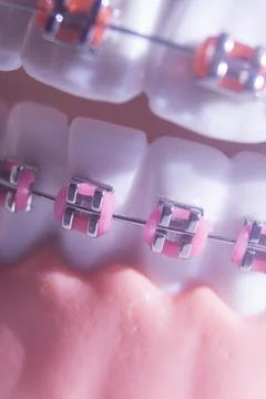 Metal teeth brackets Foto stock