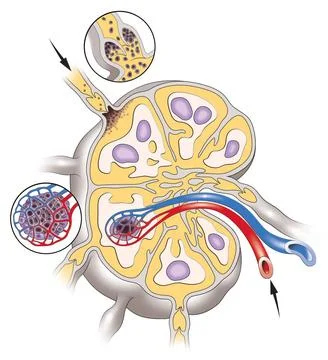  Metastasis Lymph node with metastasis. Copyright: xKERMOALx/xBSIPx 011883... Stock Photos