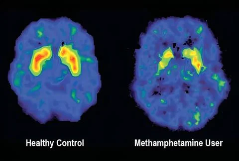  Methamphetamine abuse decreases dopamine transporter activity and comprom... 스톡 사진