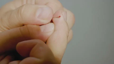 Method for self-removal of warts. Wart Removale Procedure using a needle. Stock Footage 140684132