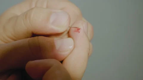 Method for self-removal of warts. Wart Removale Procedure using a needle. Stock Footage 141001388