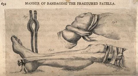 Methods of bandaging a fractured patella. Etching by J. Bell. Stock Illustration