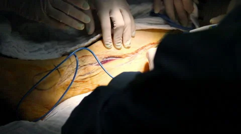Mexico, 2014: CLOSE UP-HANDHELD SHOT. Surgery team in surgery. Stock Footage 45029561