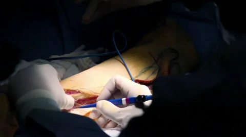 Mexico, 2014: CLOSE UP-HANDHELD SHOT. Surgery team in surgery. Stock Footage 45030991