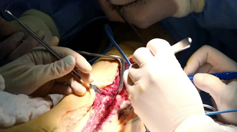 Mexico, 2014: CLOSE UP-HANDHELD SHOT. Surgery team in surgery. Stock Footage 45035854
