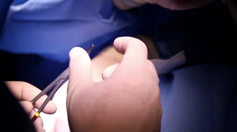 Mexico, 2014: CLOSE UP. Surgeons during operation. Stock Footage 44980755