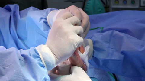 Mexico: CLOSE UP. Hands of surgeons working during a hand surgery. Stock Footage 48959639