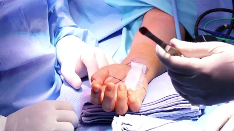 Mexico: CLOSE UP. Hands of surgeons working during a hand surgery. Stock Footage 48962271