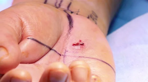 Mexico: CLOSE UP. Hands of surgeons working during a hand surgery. Stock Footage 48966909