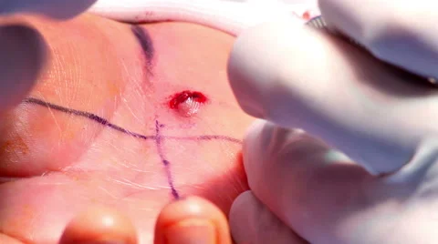 Mexico: CLOSE UP. Hands of surgeons working during a hand surgery. Stock-Footage 48968287