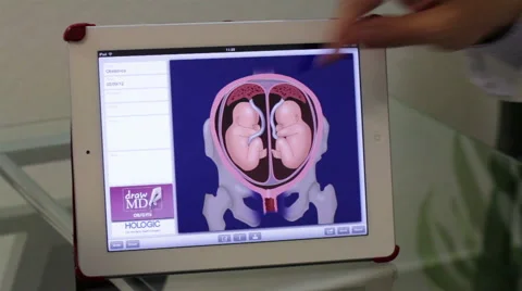 Mexico,2014:CLOSE UP-HANDHELD SHOT. Doctor explaining a twins image in a tablet Stock Footage 42851495