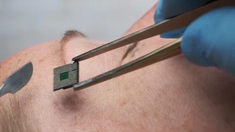 Microchipping man. Micro chip is implanted on temple on person’s head Video stock 129810399