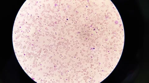 Microcytic hypochromic anemia with abnormal RBC Video stock 337722840