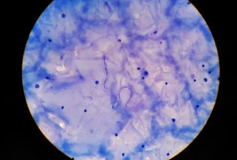 Microfilaria tissue parasite infection to human. Stock Photos