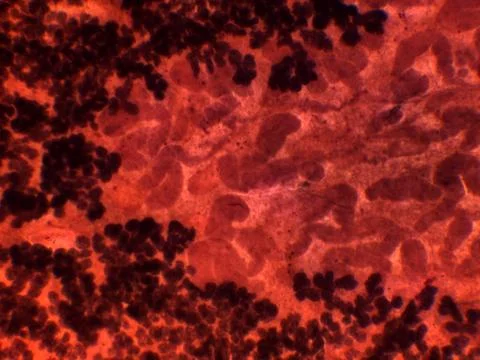 Micrograph of Hepatic Tissue Damage Showing Necrosis and Hemorrhagic Foci A.. 写真素材