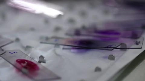 Microscope slides with cancer cells on them Stock Footage 41416895