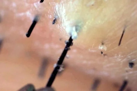 Microscope view of hair removal from the root Stock Footage 333611835