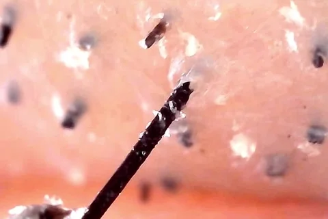 Microscope view of hair removal from the root Stock Footage 333611878