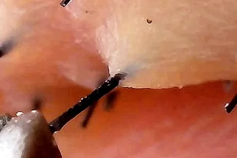 Microscope view of hair removal from the root Stock Footage 333611885