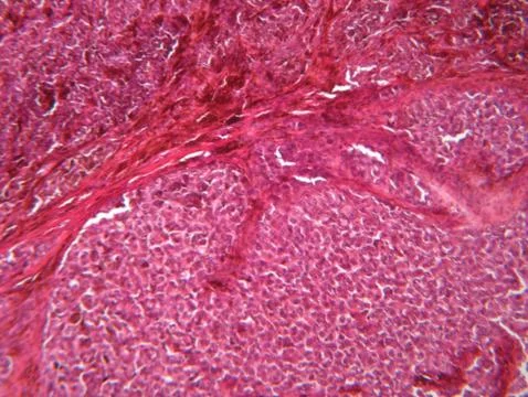 Microscope view of malignant melanoma Stock Photos
