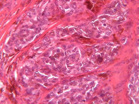 Microscope view of malignant melanoma Stock Photos
