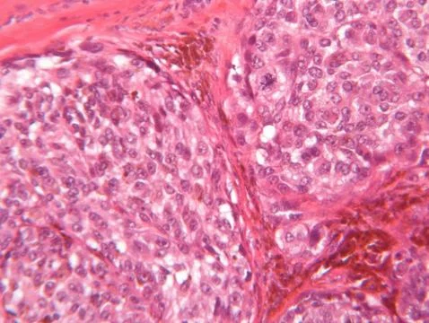 Microscope view of malignant melanoma Stock Photos