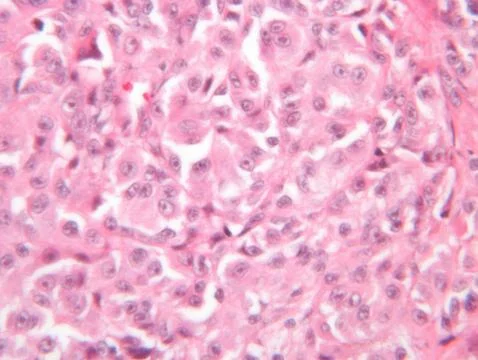 Microscope view of malignant melanoma Stock Photos