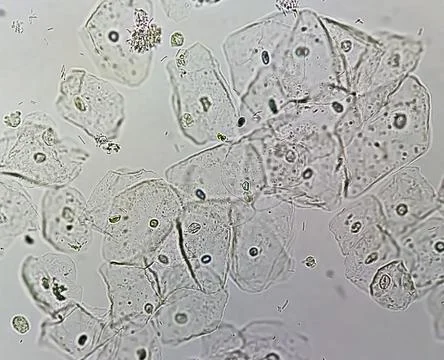 Microscopic close view of Abnormal urinalysis. Epithelial cell, Pus cell, RBC 스톡 사진