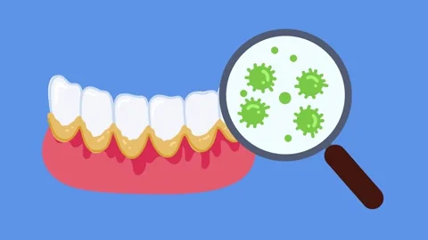 Microscopic dental plaque bacteria spreading on teeth Stock Footage 336159865