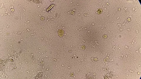 Microscopic footage of stool analysis showing plus cell and bacteria Video stock 337722823