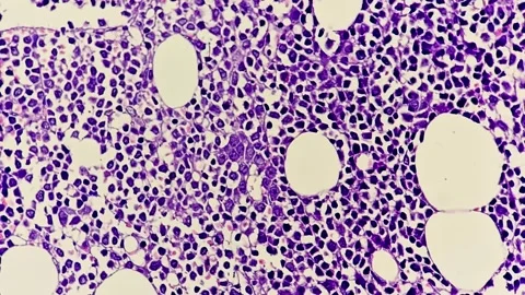 Microscopic footage of Trephine Biopsy showing Acute Leukemia Video stock 337723331