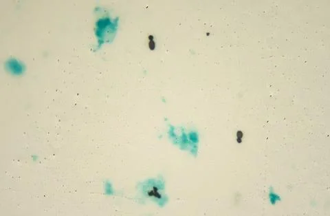 Microscopic image of a Histoplasmosis in Grocott staining. Stock Illustration