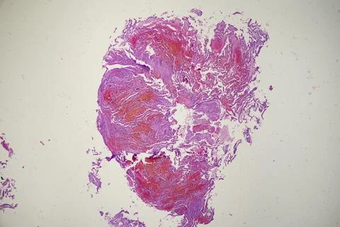 Microscopic image of lung and systemic lupus erythematosus. Stock Photos