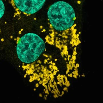Microscopic image of mutated human epithelial cells Stock Photos