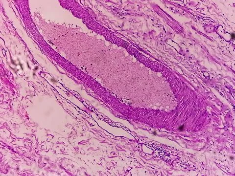 Microscopic image or photomicrograph of Fallopian tube biopsy. 스톡 사진