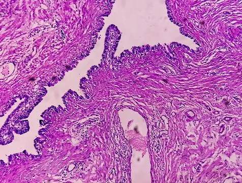 Microscopic image or photomicrograph of Fallopian tube biopsy. Foto stock
