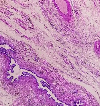 Microscopic image or photomicrograph of Fallopian tube biopsy. 스톡 사진