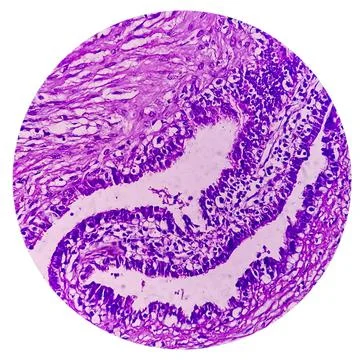 Microscopic image or photomicrograph of Fallopian tube biopsy. Foto stock