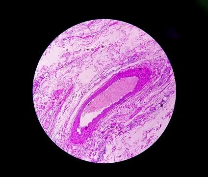 Microscopic image or photomicrograph of Fallopian tube biopsy. Foto stock