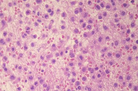 Microscopic image of a rhabdoid sarcoma Stock-Fotos