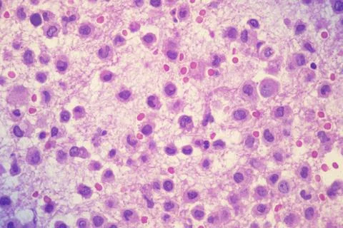 Microscopic image of a rhabdoid sarcoma Stock Photos