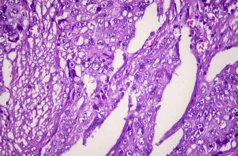 Microscopic image showing an endometrial carcinoma with metastasis to the ileum. Stock Illustration