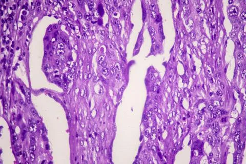 Microscopic image showing an endometrial carcinoma with metastasis to the ileum. 스톡 일러스트