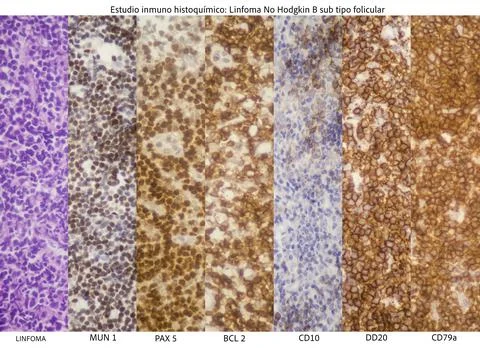 Microscopic image showing a follicular subtype of B-cell non-Hodgkin lymphoma. Stock Photos
