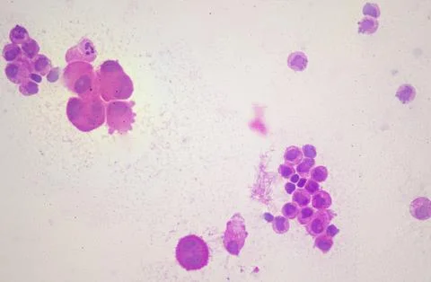 Microscopic image showing metastatic breast adenocarcinoma in pleural fluid. Stock Illustration