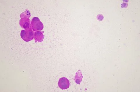 Microscopic image showing metastatic breast adenocarcinoma in pleural fluid. Stock Illustration